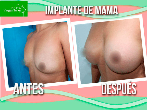 Implante-de-mama-(28)