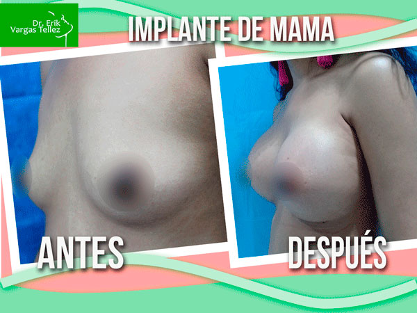 Implante-de-mama-(30)