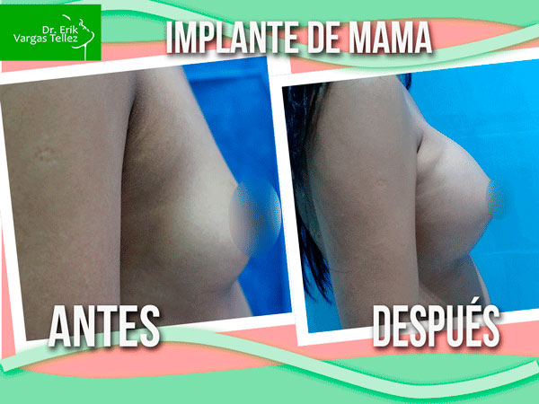 Implante-de-mama-(32)