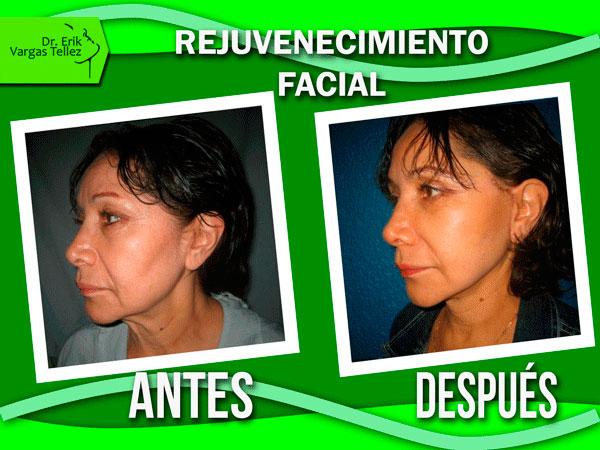 Rejuvenecimiento-Facial1