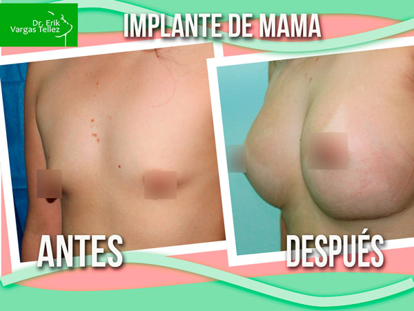 implantes-de-mama-3-5