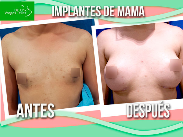 implantes-de-mama-5-1