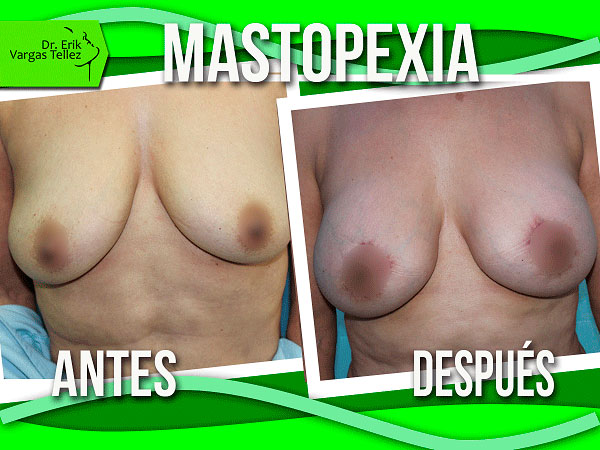 mastopexia-(2)