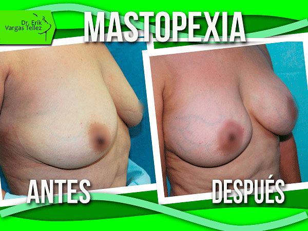 mastopexia-(5)